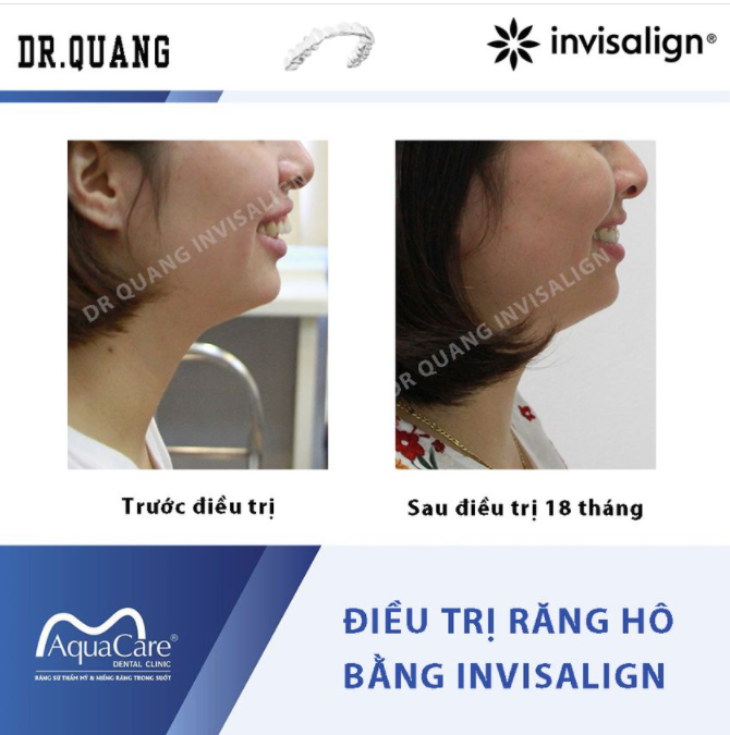 Niềng răng là cả một quá trình dài và kiên trì