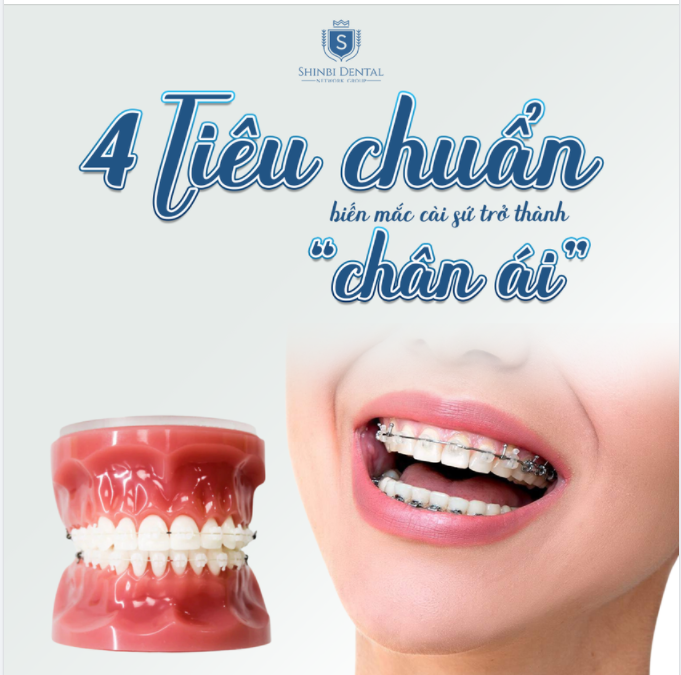 NIỀNG RĂNG MẮC CÀI SỨ ĐÁP ỨNG 4 TIÊU CHUẨN CỦA GIỚI TRẺ