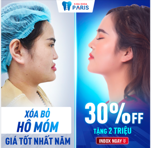 Niềng răng Phẫu thuật chỉnh hàm  Xoá bỏ 100% Hô Móm