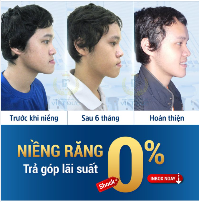 NIỀNG RĂNG SỚM - RÚT NGẮN THỜI GIAN ĐIỀU TRỊ