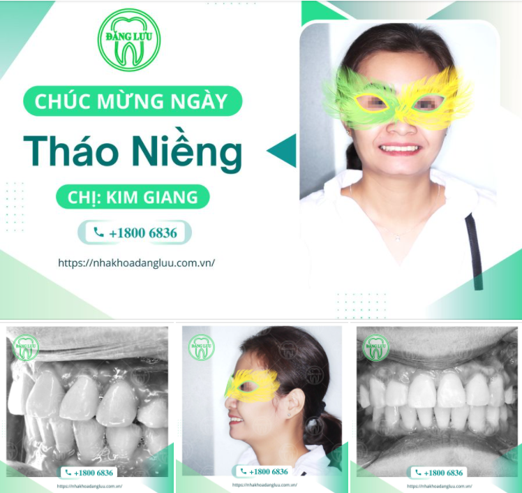 NIỀNG RĂNG THÀNG CÔNG Ở TUỔI 42