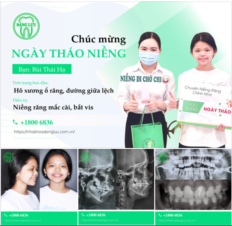 NIỀNG RĂNG THÀNH CÔNG Ở TUỔI 15