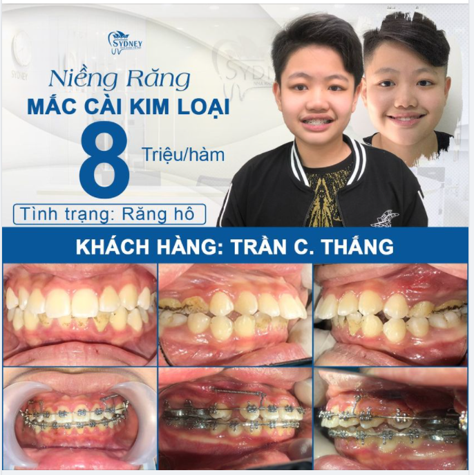 NIỀNG RĂNG THỜI ĐIỂM VÀNG - RÚT NGẮN THỜI GIAN TỐI ĐA