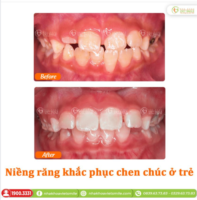 NIỀNG RĂNG TRẺ EM - CẢI THIỆN CHEN CHÚC SAU 10 THÁNG