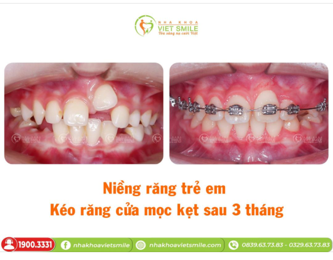 NIỀNG RĂNG TRẺ EM - KÉO RĂNG CỬA MỌC KẸT SAU 3 THÁNG
