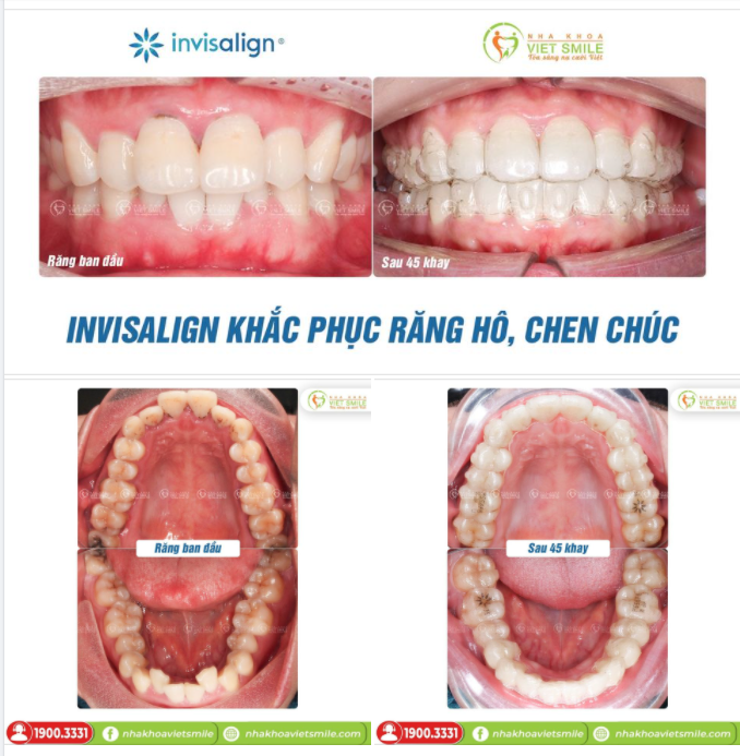 NIỀNG RĂNG TRONG SUỐT INVISALIGN