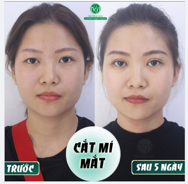 NỔI BẬT HƠN VỚI ĐÔI MẮT 2 MÍ ĐỀU ĐẶN