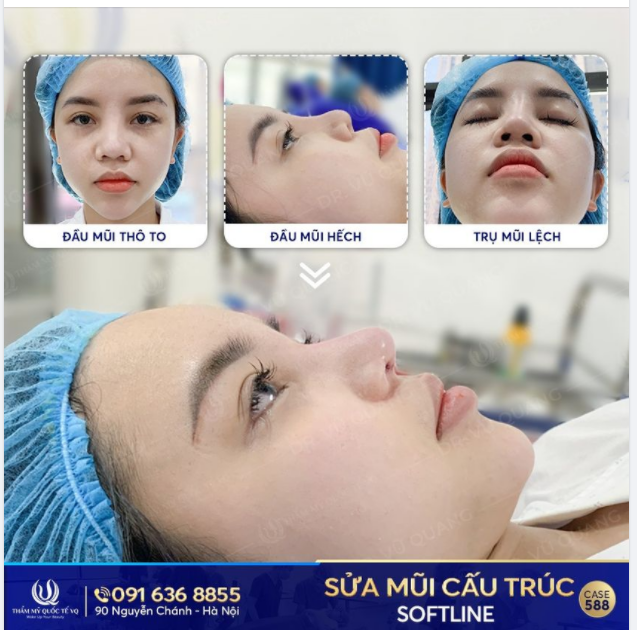 Nỗi đau của người của người Mũi hỏng vì phẫu thuật thẩm mỹ.
