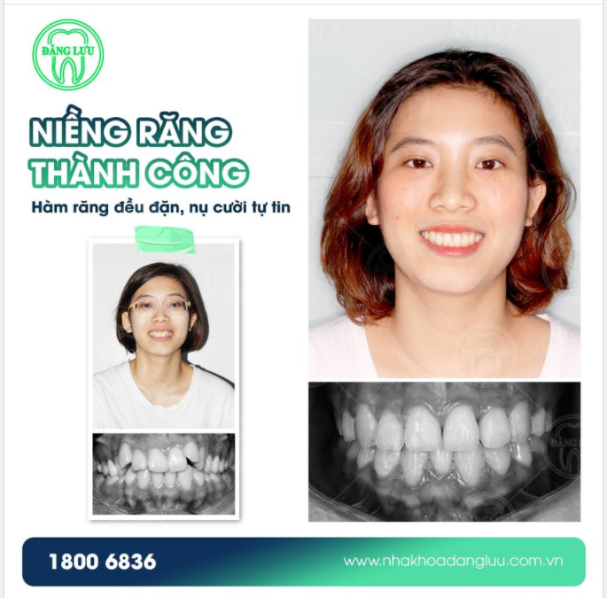 Nụ cười hoàn hảo nhờ niềng răng thành công