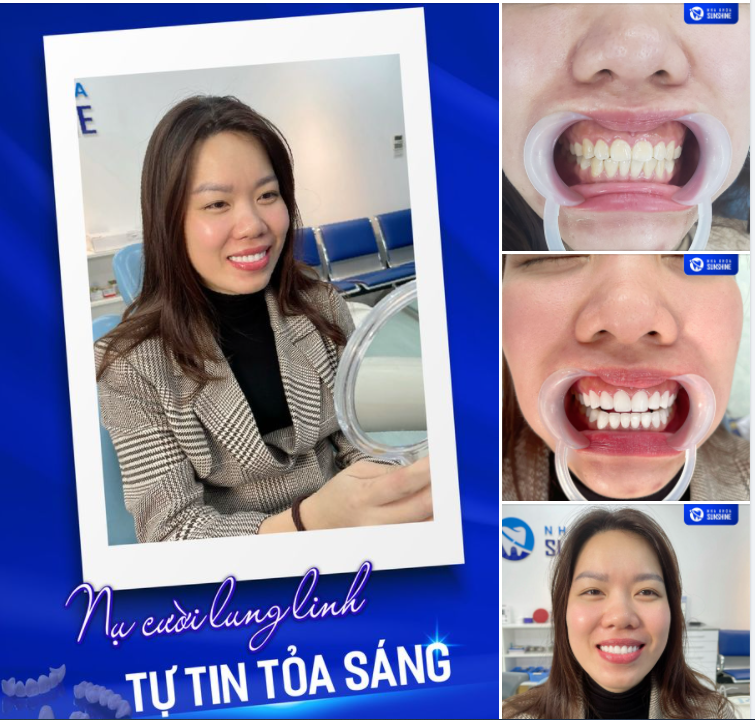 NỤ CƯỜI LUNG LINH – TỰ TIN TOẢ SÁNG