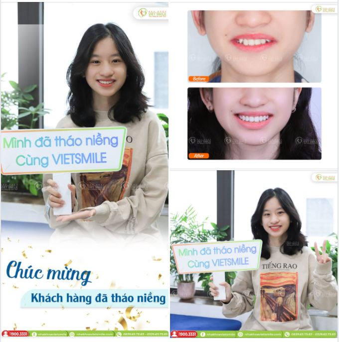 NỤ CƯỜI RẠNG RỠ SAU THÁO NIỀNG RĂNG KHẤP KHỂNH