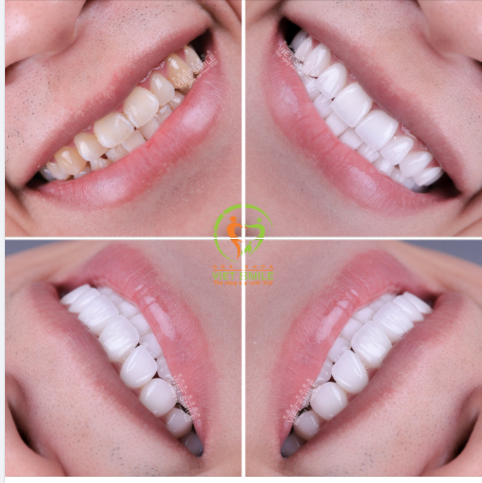 NỤ CƯỜI THU HÚT, TỰ TIN HƠN CÙNG RĂNG SỨ THẨM MỸ