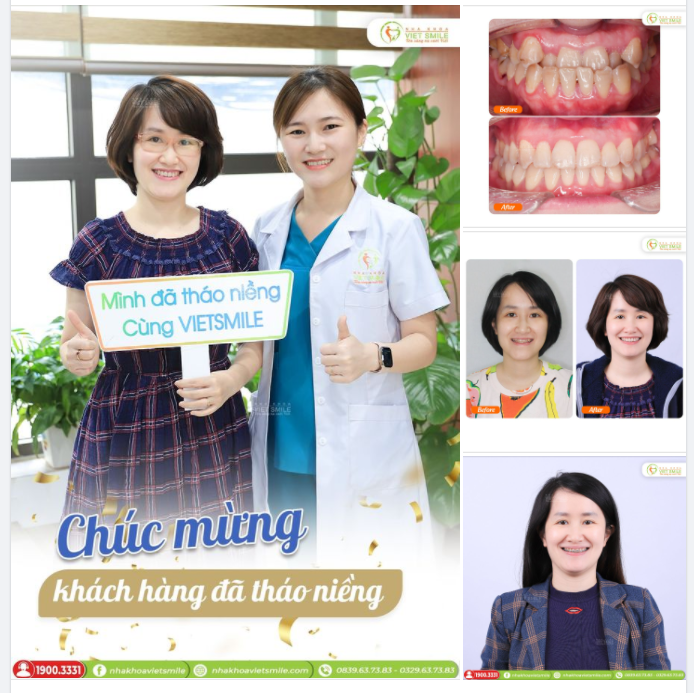 NỤ CƯỜI TỰ TIN, KHỚP CẮN TỐT SAU THÁO NIỀNG RĂNG MÓM