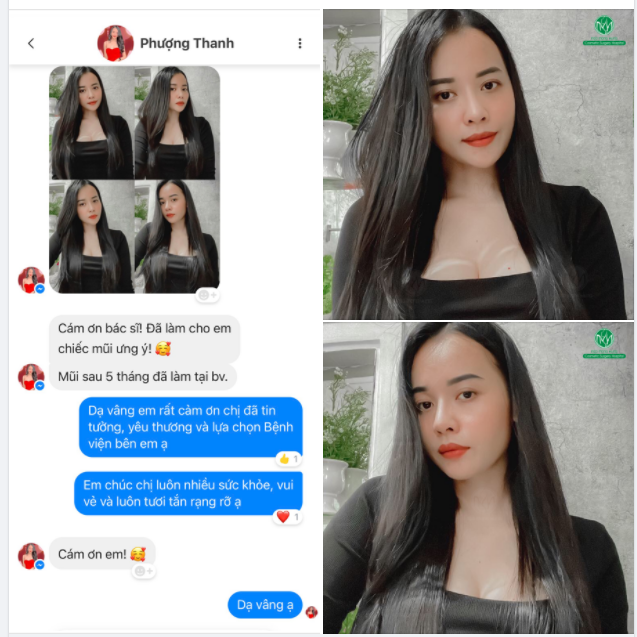 PHẢN HỒI CHÂN THỰC TỪ KH ĐÃ LÀM MŨI 5 THÁNG