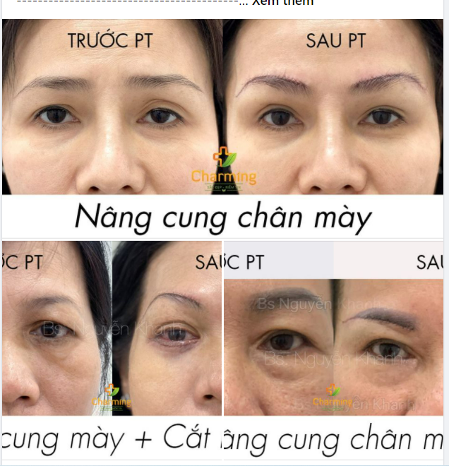 PHẪU THUẬT NÂNG CUNG MÀY