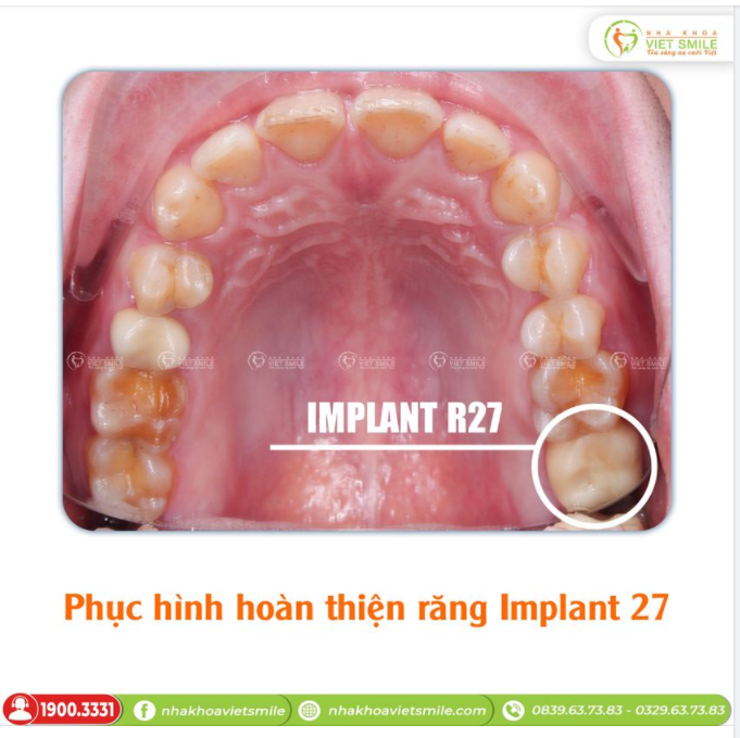 PHỤC HÌNH HOÀN THIỆN RĂNG IMPLANT 47