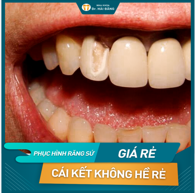 Phục hình răng sứ giá rẻ - cái kết không hề rẻ