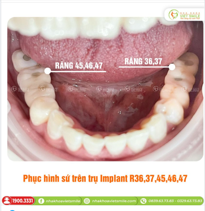 PHỤC HÌNH RĂNG SỨ TRÊN TRỤ IMPLANT 5 RĂNG HÀM DƯỚI