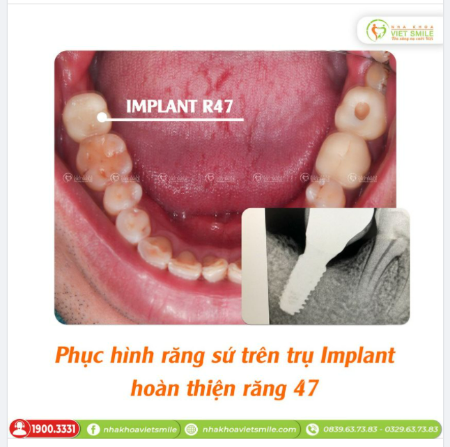 PHỤC HÌNH RĂNG SỨ TRÊN TRỤ IMPLANT OSSTEM - HOÀN THIỆN RĂNG HÀM 47