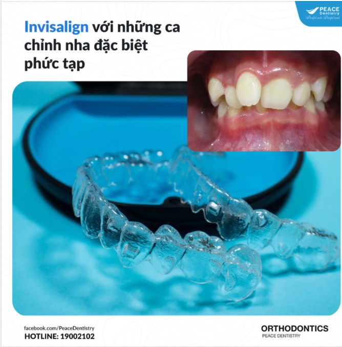 Q&A: Chỉnh nha (niềng răng) Invisalign