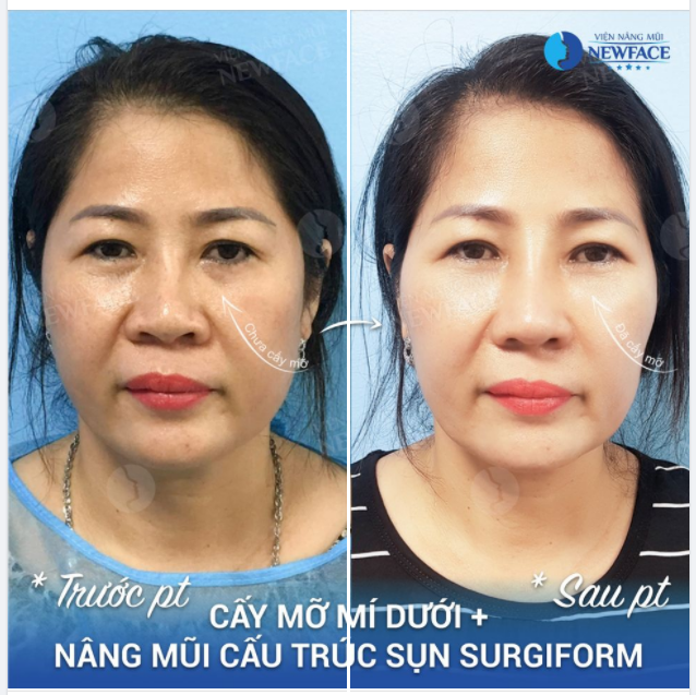 QUÁ KHÁC BIỆT SAU COMBO NÂNG MŨI + CẤY MỠ MÍ DƯỚI
