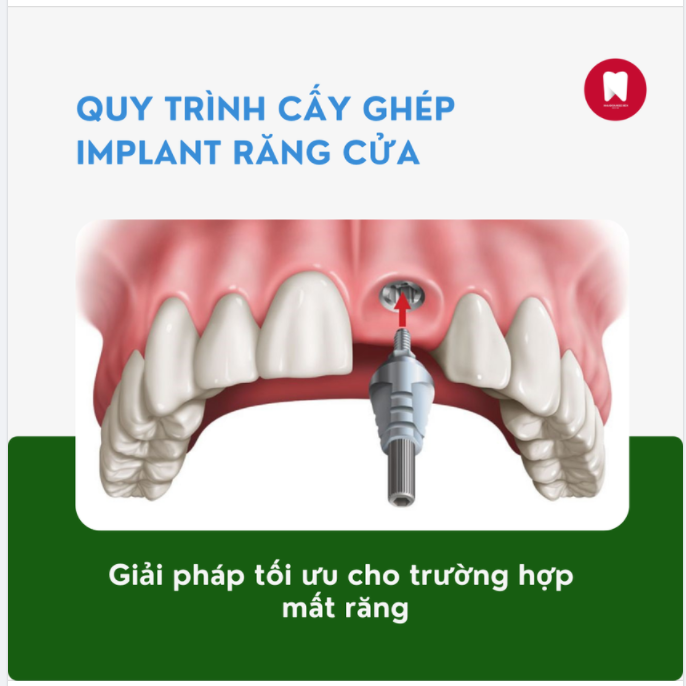 QUY TRÌNH CẤY GHÉP IMPLANT RĂNG CỬA