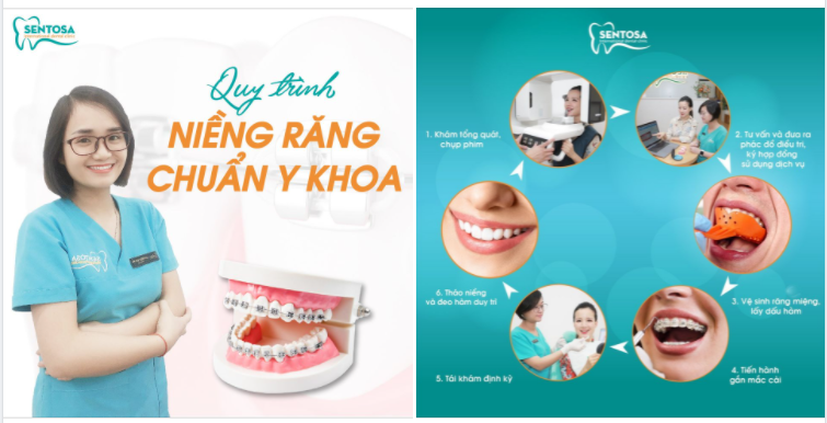 QUY TRÌNH NIỀNG RĂNG MẮC CÀI TẠI NHA KHOA SENTOSA