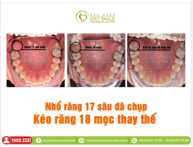 RĂNG 8 (RĂNG KHÔN) CÓ THỰC SỰ MỌC NGU
