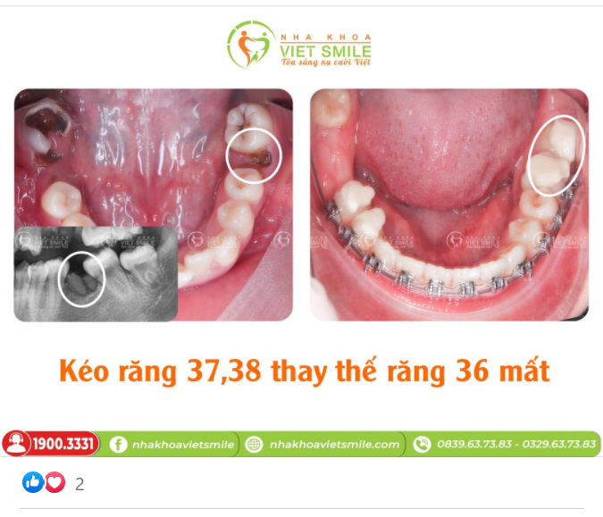 RĂNG 8 (RĂNG KHÔN) CÓ THỰC SỰ MỌC "NGU"?