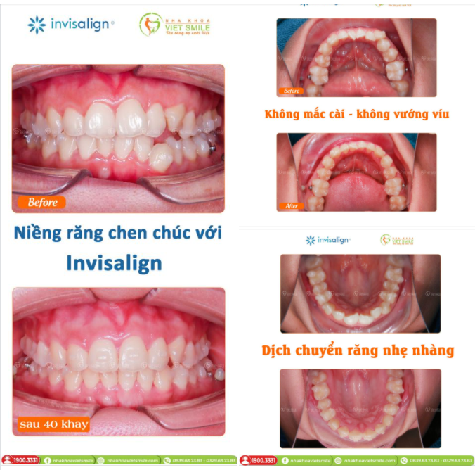 RĂNG CHEN CHÚC THAY ĐỔI RA SAO SAU 40 KHAY INVISALIGN?