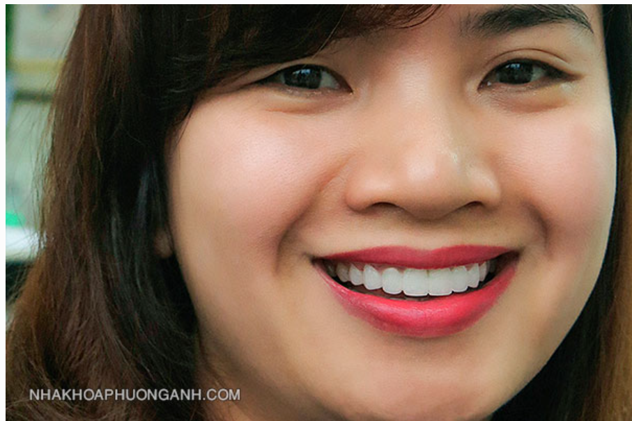 Răng cửa như thế nào được gọi là đẹp?