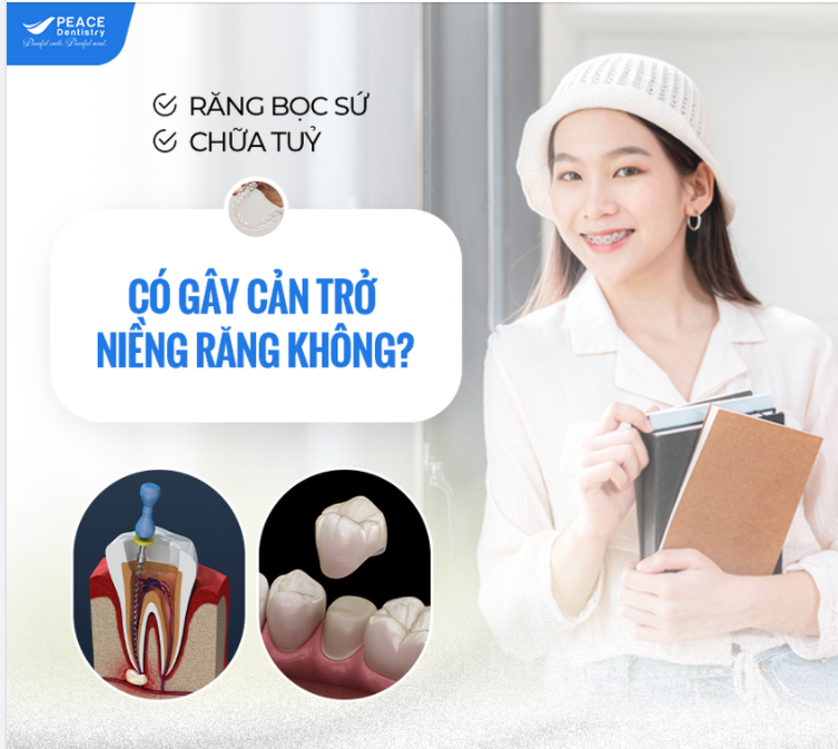 RĂNG ĐÃ BỌC SỨ, CHỮA TUỶ CÓ GÂY CẢN TRỞ VIỆC NIỀNG RĂNG HAY KHÔNG