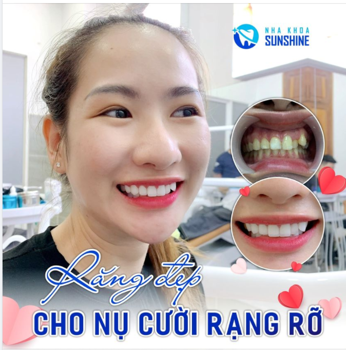 RĂNG ĐẸP CHO NỤ CƯỜI RẠNG RỠ