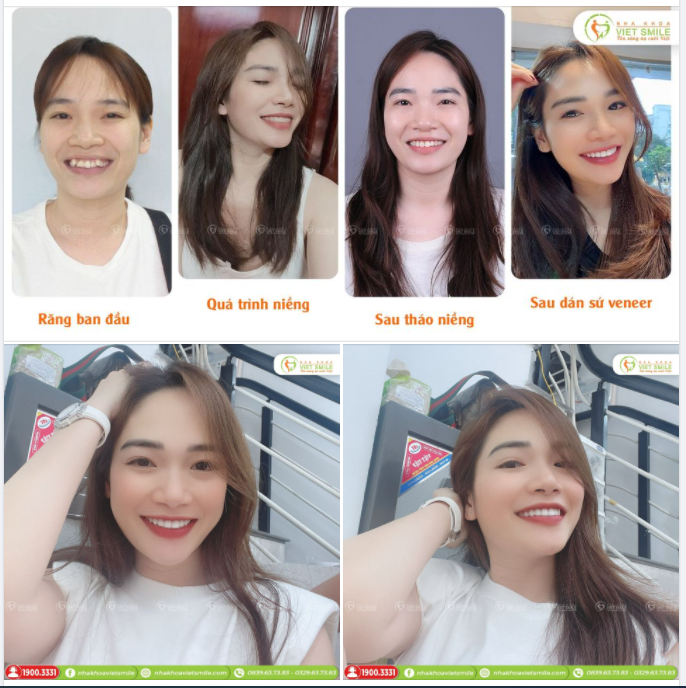 RĂNG ĐỀU ĐẸP, NỤ CƯỜI RẠNG RỠ SAU NIỀNG RĂNG  DÁN SỨ VENEER