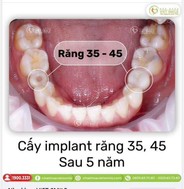 RĂNG IMPLANT CHẮC KHỎE - BỀN ĐẸP CÙNG THỜI GIAN