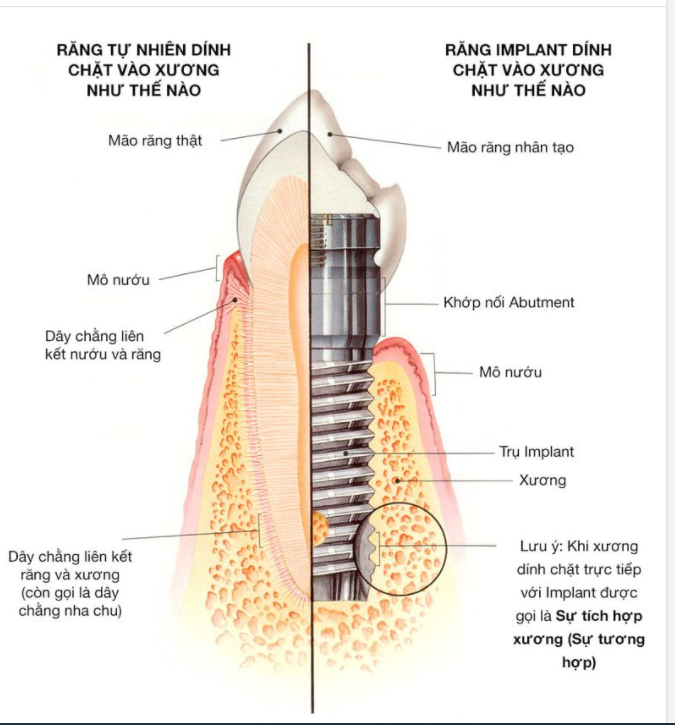 RĂNG IMPLANT MANG LẠI GIÁ TRỊ LÝ TƯỞNG TƯƠNG ĐỒNG NHƯ RĂNG THẬT