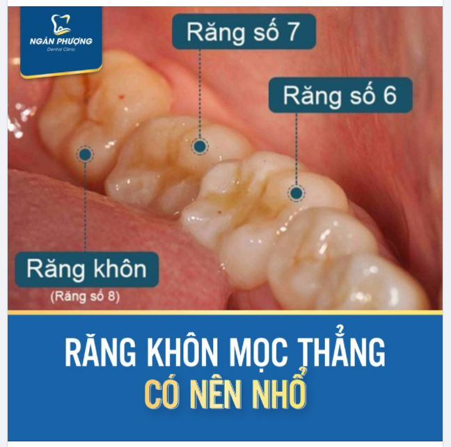 Răng khôn mọc thẳng có nên nhổ