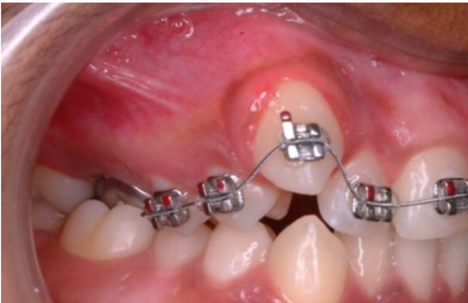 Răng mọc lệch xử lý cách nào?