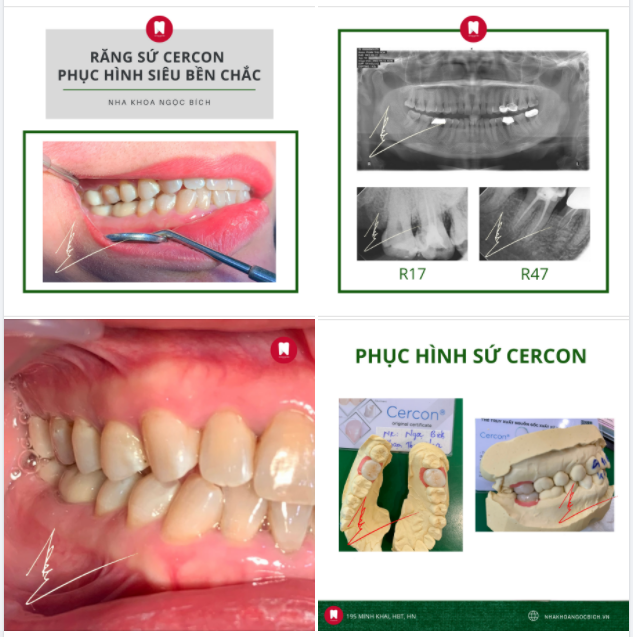 RĂNG SỨ CERCON - PHỤC HÌNH SIÊU BỀN CHẮC