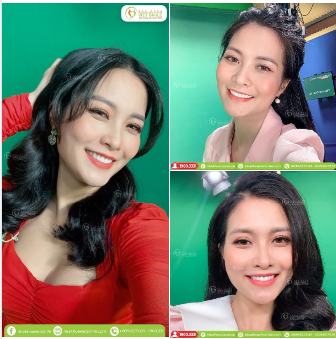 RĂNG SỨ THẨM MỸ - NỤ CƯỜI RẠNG NGỜI, TỰ TIN TỎA SÁNG