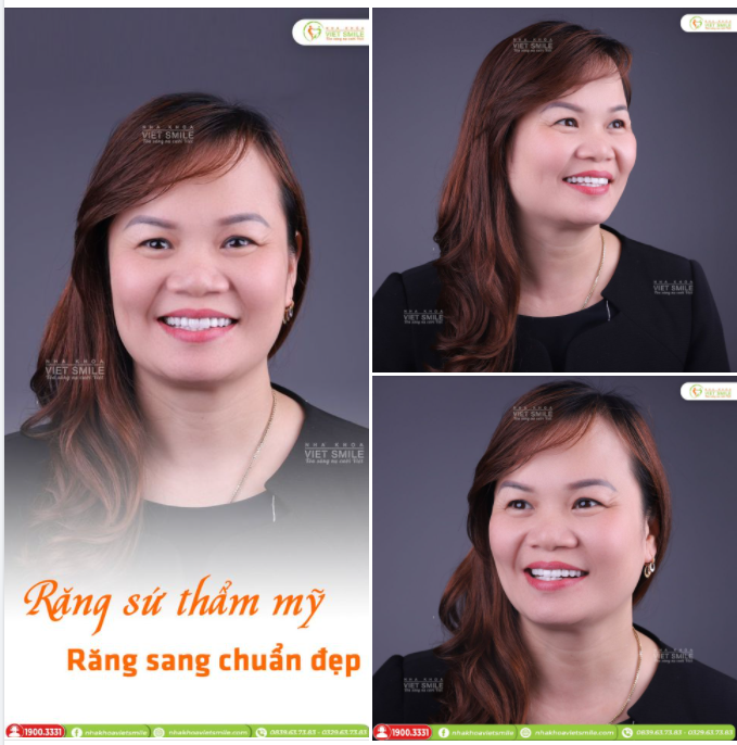 RĂNG SỨ THẨM MỸ - RĂNG SANG CHUẨN ĐẸP