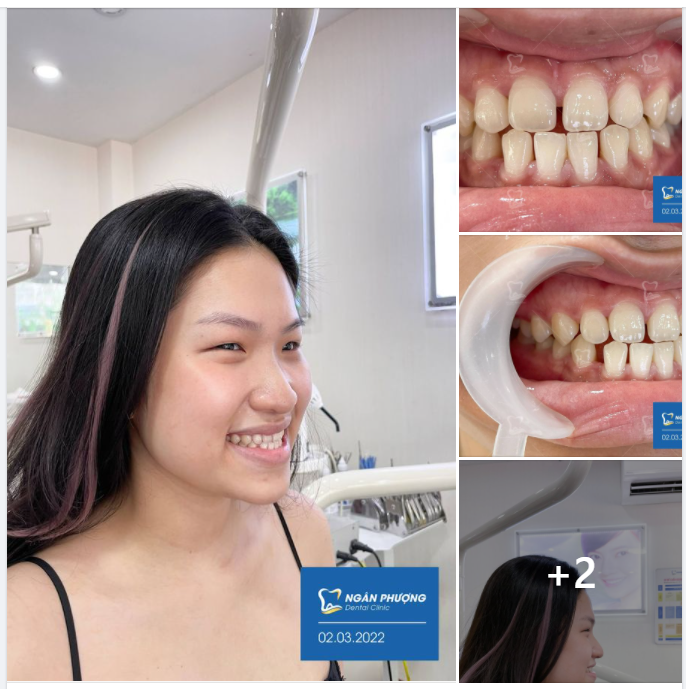 Răng thưa lại thêm khớp cắn đối đầu - chớ nên xem thường