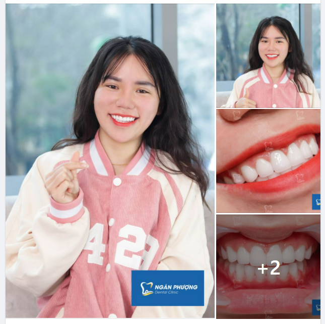 Răng trắng có làm anh lo lắng