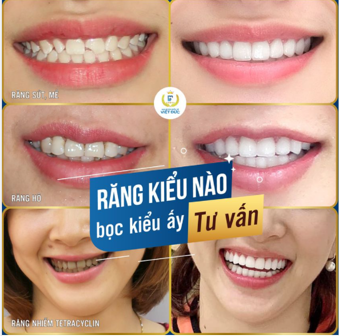 RĂNG XẤU THẾ NÀO - BỌC SỨ CŨNG XINH