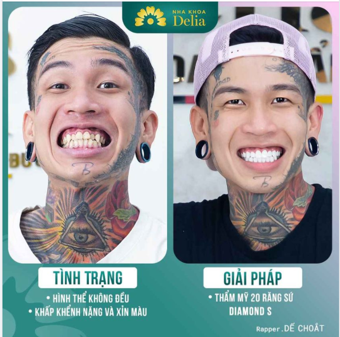 Rapper Dế Choắt  - Sau 48h sở hữu ngay hàm răng đều, trắng sáng.