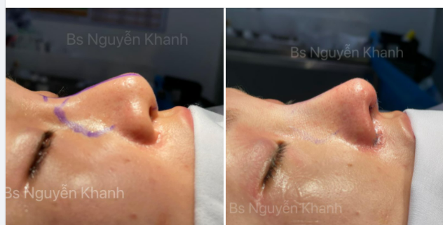 Sáng nay làm xong ca mũi cấu trúc, ngắm ngắm chụp hình. Chợt nhận thấy kết quả làm ra giống mấy tấm hình mũi lót sụn tối qua mình post fb.