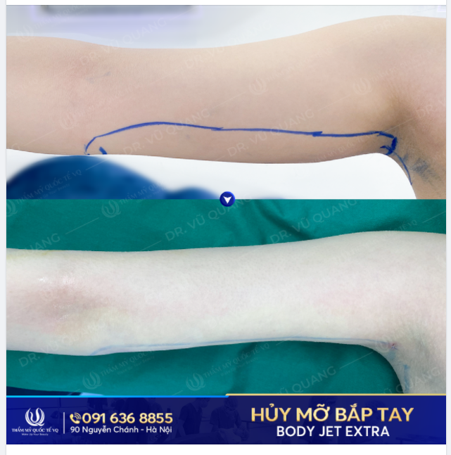 Sao phải muộn phiền vì bắp tay  LỰC ĐIỀN