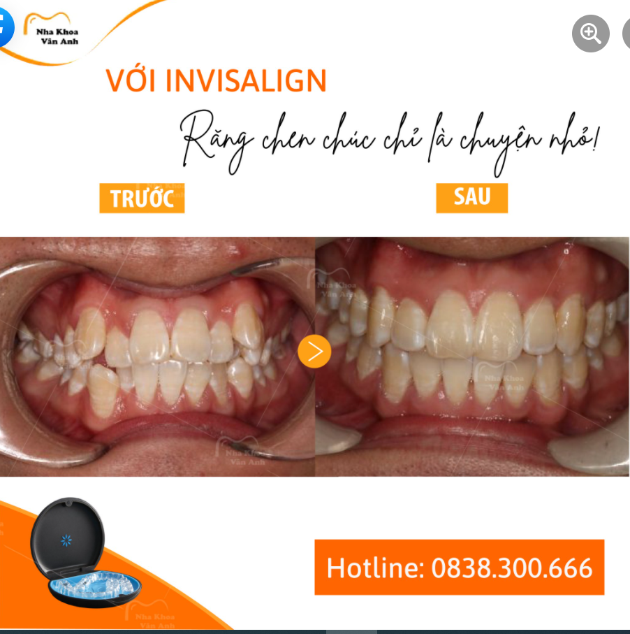 SẮP XẾP LẠI TRẬT TỰ RĂNG “DỄ DÀNG NHƯ ĂN KẸO” NHỜ