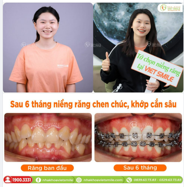 SAU 6 THÁNG NIỀNG RĂNG CHEN CHÚC, KHỚP CẮN SÂU THAY ĐỔI RA SAO