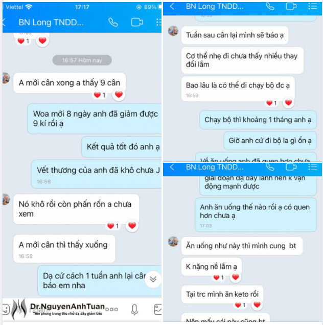 Sau 8 ngày thực hiện Thu nhỏ Dạ dày giảm béo, nam bệnh nhân có chỉ số Khối cơ thể BMI 38 (115kg) đã giảm 9kg